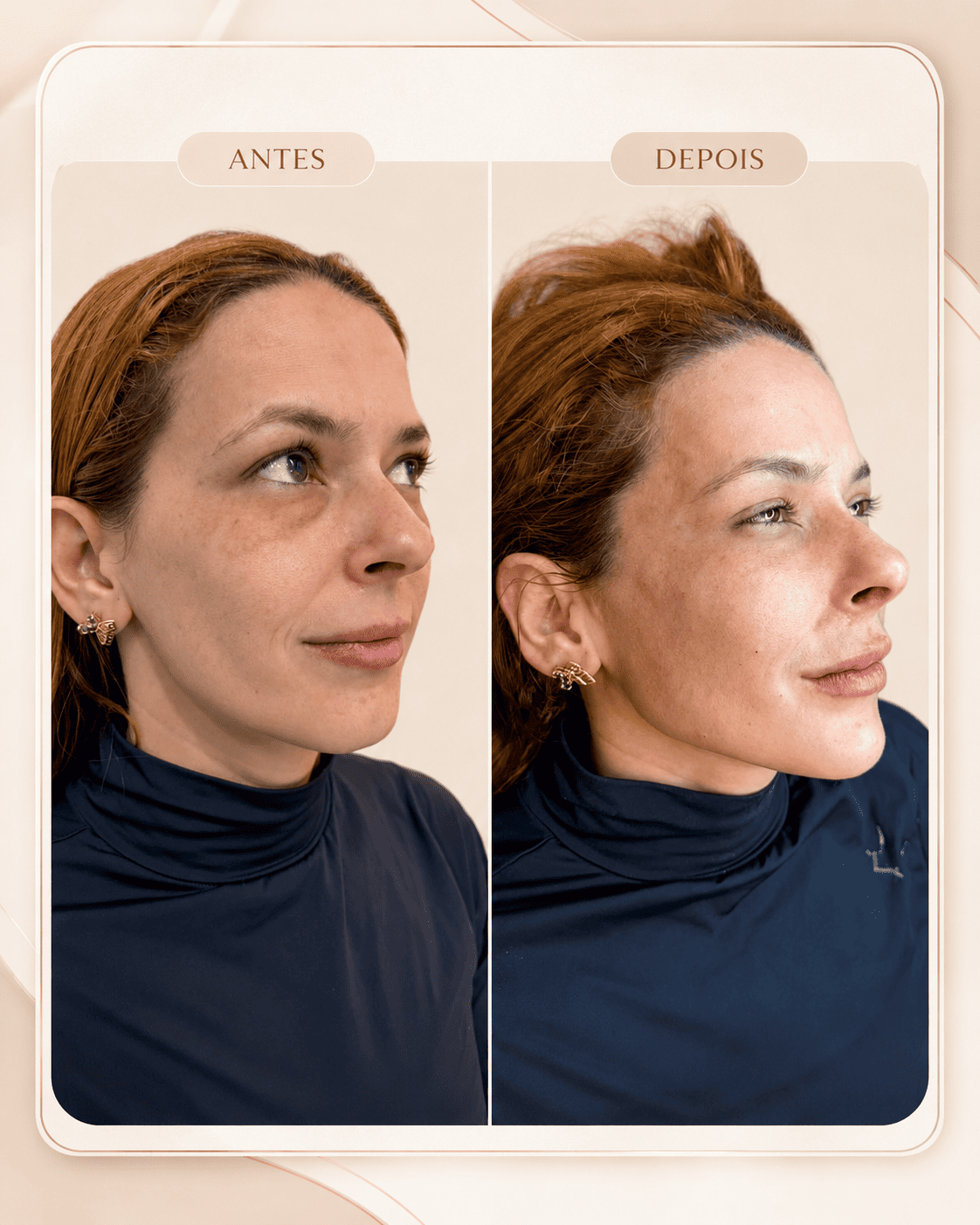 Harmonização Facial — resultado 1