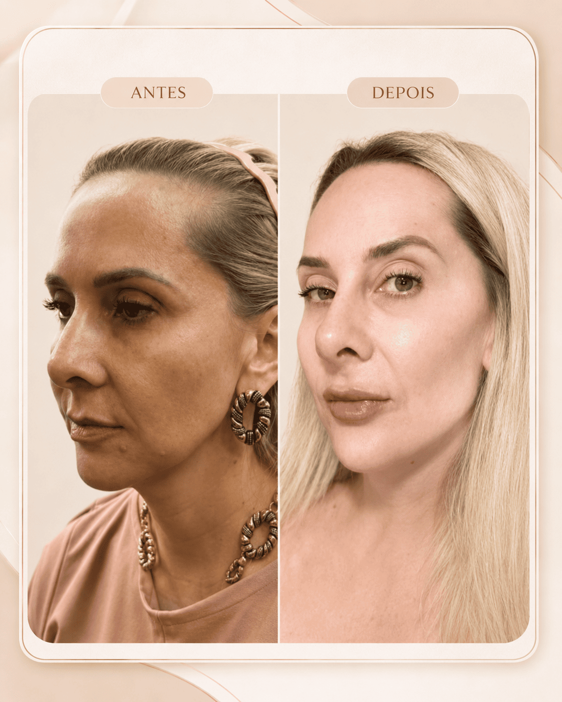 Harmonização Facial — resultado 2