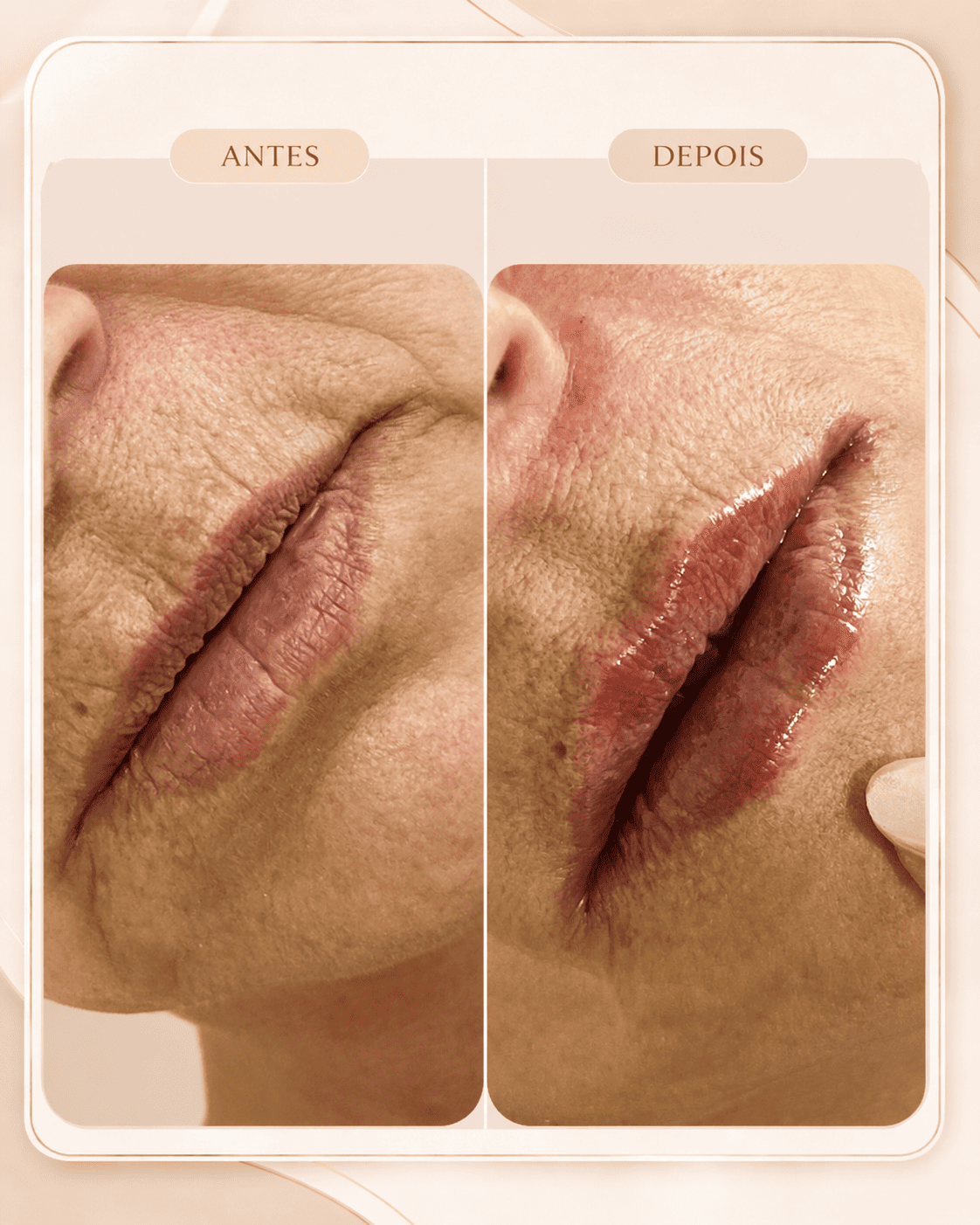 Harmonização Facial — resultado 4