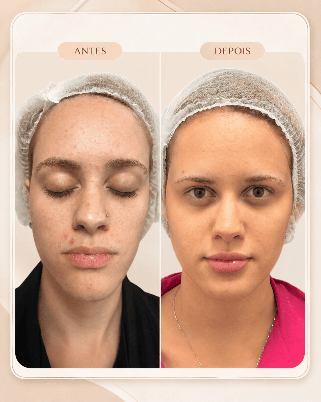 Harmonização Facial — resultado 3